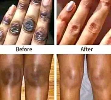 Skin Lightening| Brightening| Bleaching+27 81 850 2816