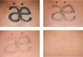 Tattoo Remover Cream In Kampala+27 81 850 2816