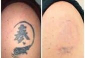 Tattoo Remover Cream In Kampala+27 81 850 2816