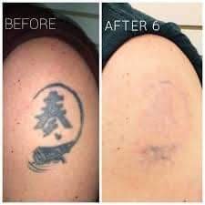 Tattoo Remover Cream In Kampala+27 81 850 2816