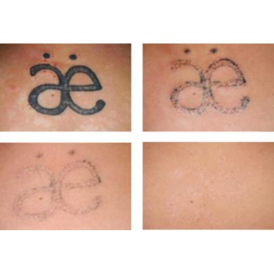 Tattoo Remover Cream In Kampala+27 81 850 2816
